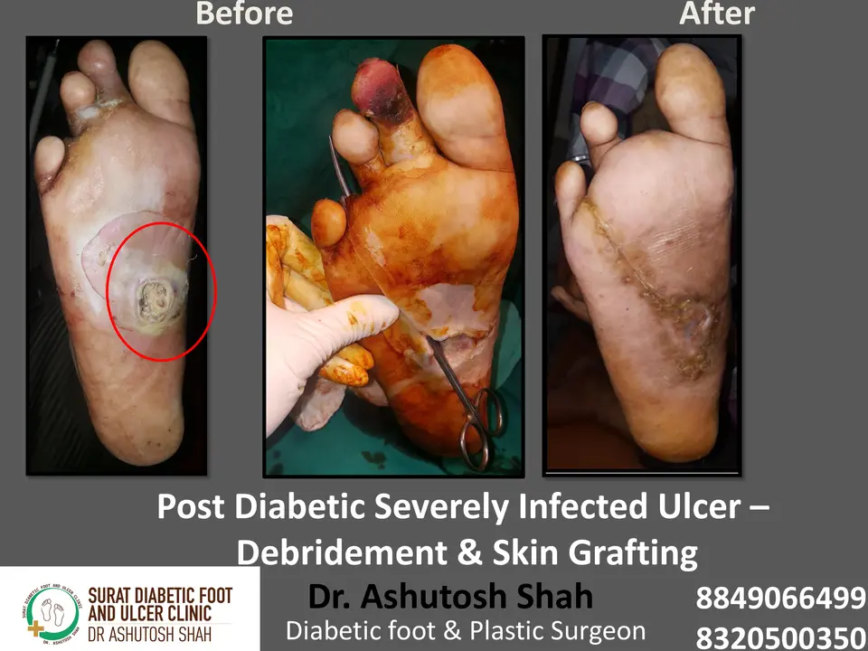 Diabetic Foot  PPT 3 checked by sir.pptx-50.webp